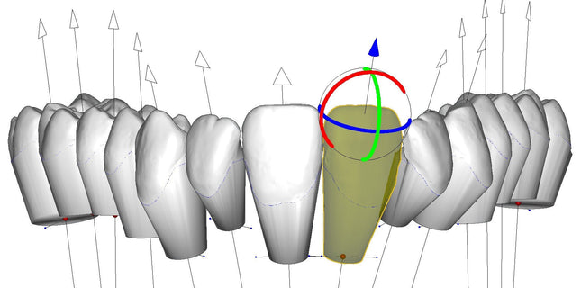 Logiciel-Logiciel de Conception 3D de gouttières aligneurs pour l'Orthodontie DeltaFace Aligner- DELTAFACE - KALLISTO